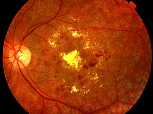retinopatía diabetica grave